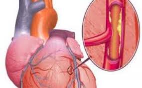 Penyakit jantung koroner