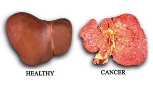 Kanker hati