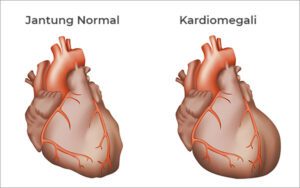 Risiko Penyakit Jantung Lebih Awal