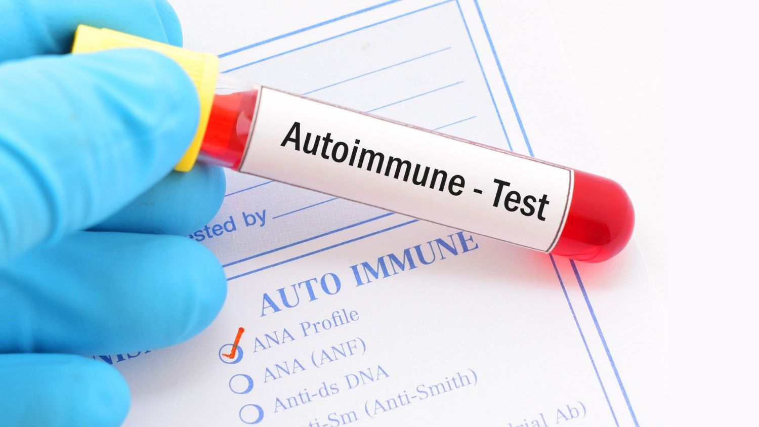 Mengapa Penyakit Autoimun Semakin Banyak di Era Modern