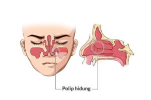 Produksi Lendir Berlebihan dan Batuk Kronis