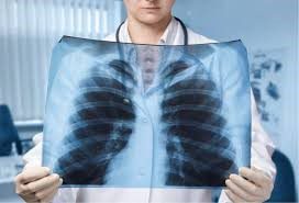 TBC Tidak Hanya Menyerang Paru-Paru