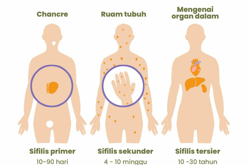 Diagnosis Sifilis