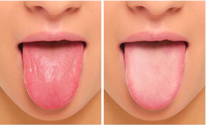 Lidah Kotor dan Berlapis Putih