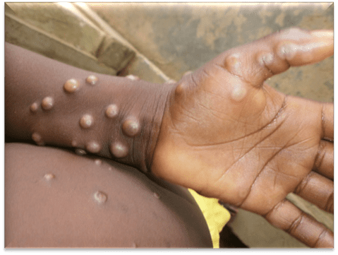 Mpox (Monkeypox)