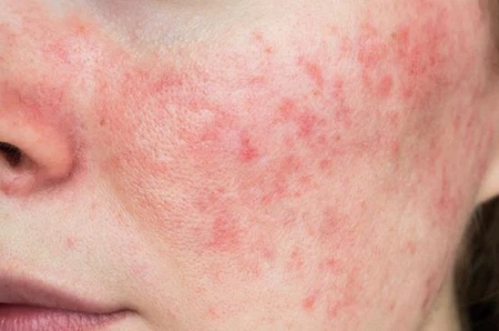 Penggunaan Produk Skincare yang Tidak Cocok