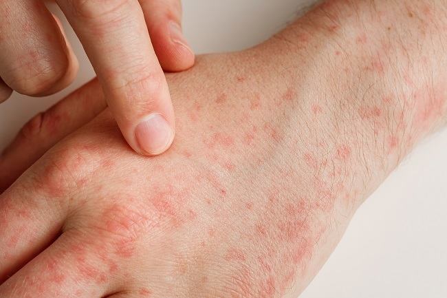 Ruam Tidak Langsung Muncul