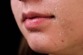 Kulit Menjadi Kering dan Kusam