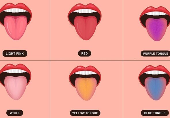 5 Warna Lidah yang Bisa Mengungkap Masalah Kesehatan Tersembunyi