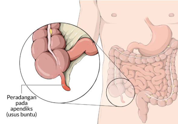 5 Gejala Utama Usus Buntu