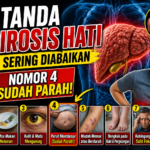7 Tanda Sirosis Hati yang Sering Diabaikan, Nomor 4 Sudah Parah